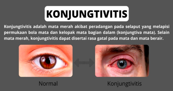 gejala sakit mata merah