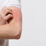 6 Cara Mengatasi Alergi Kulit Pada Tubuh