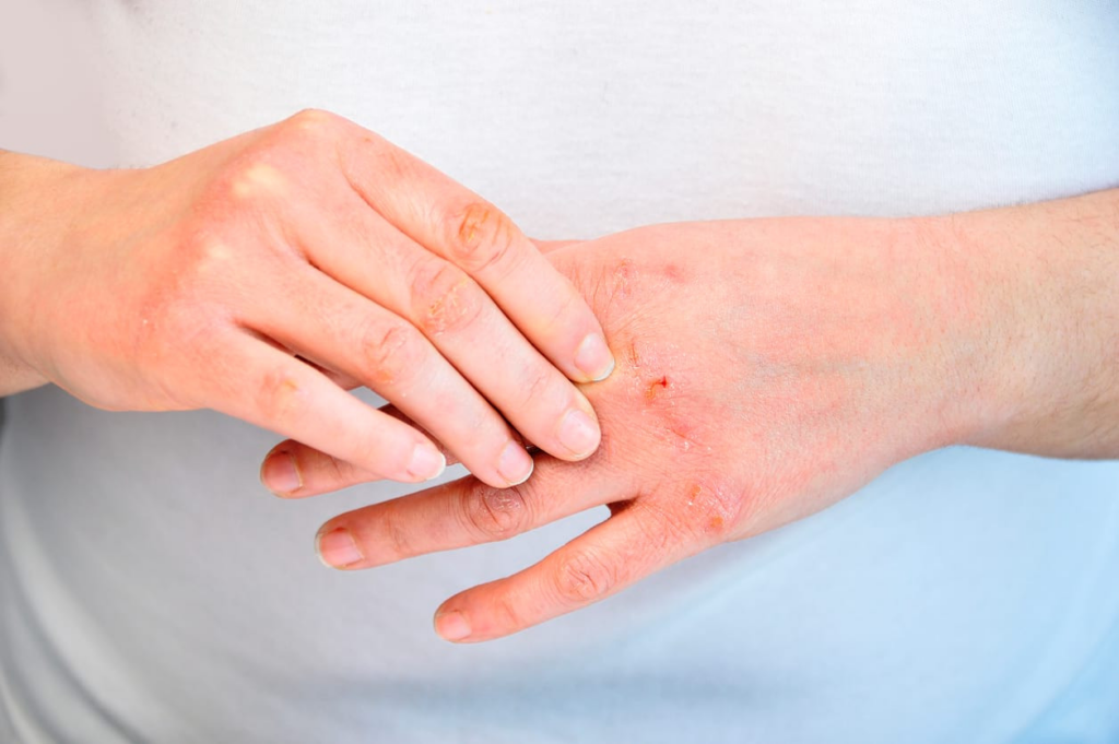 Cara Mengatasi Alergi Kulit Dilihat dari Terjadinya Hal Tersebut