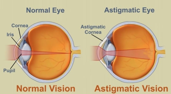 Astigmatisme : Mencari Tahu Penyebab Mata Silinder