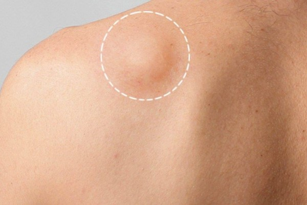 How to Remove a Lipoma Yourself